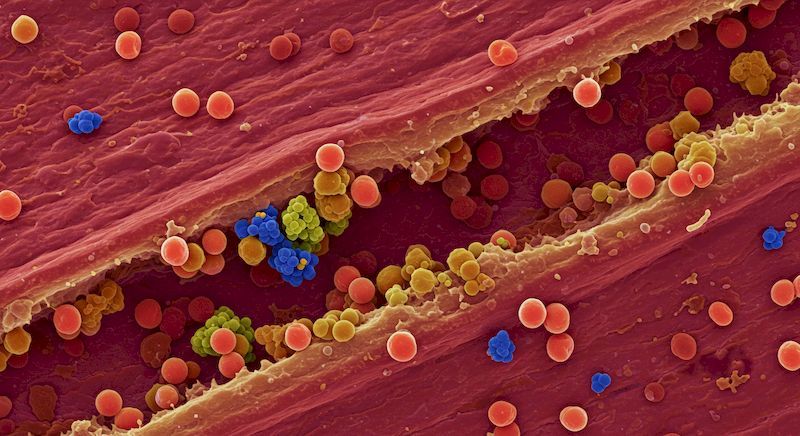 저밀도 콜레스테롤(LDL)의 특징과 기준 수치